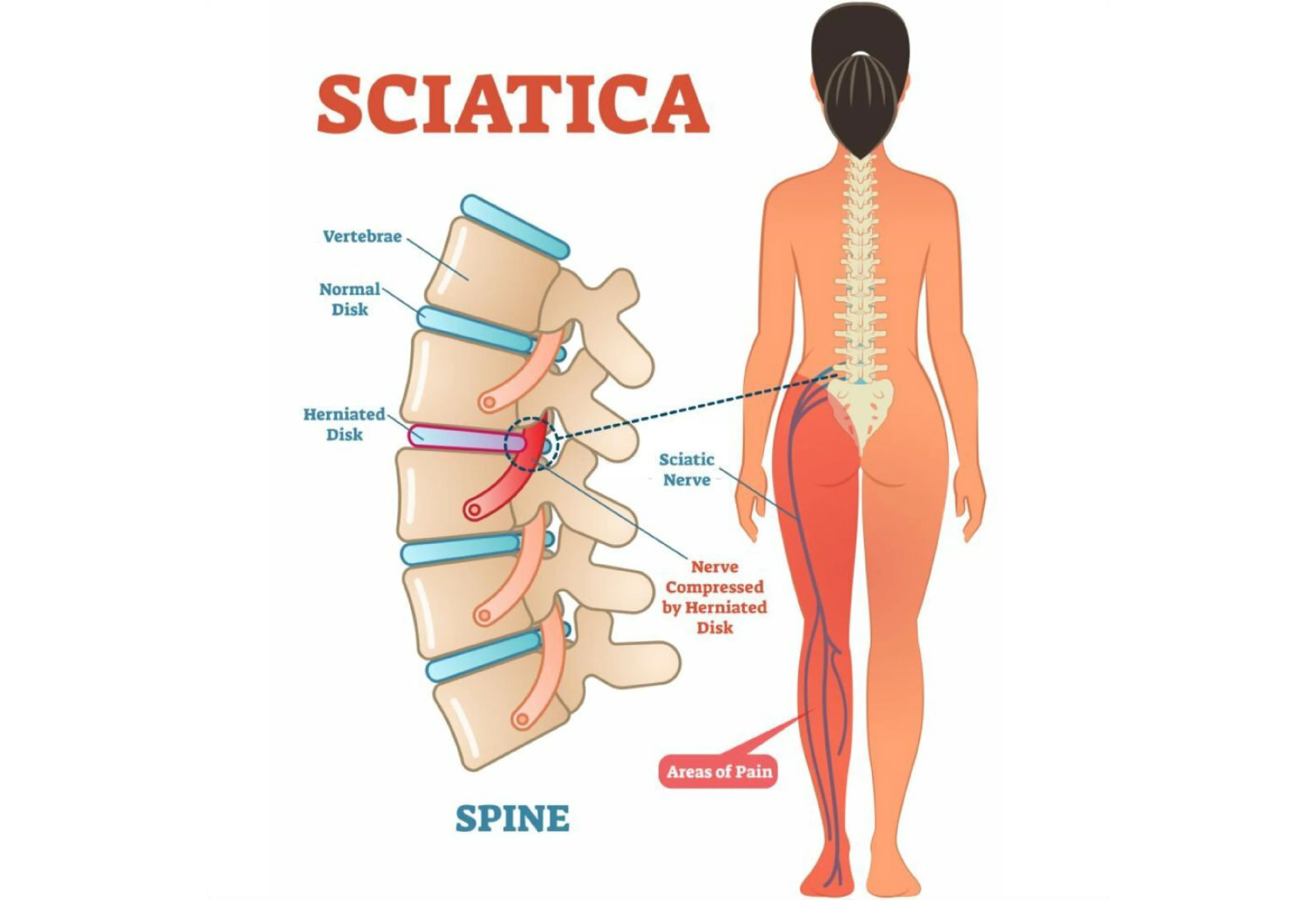 Sciatica Pain Treatment